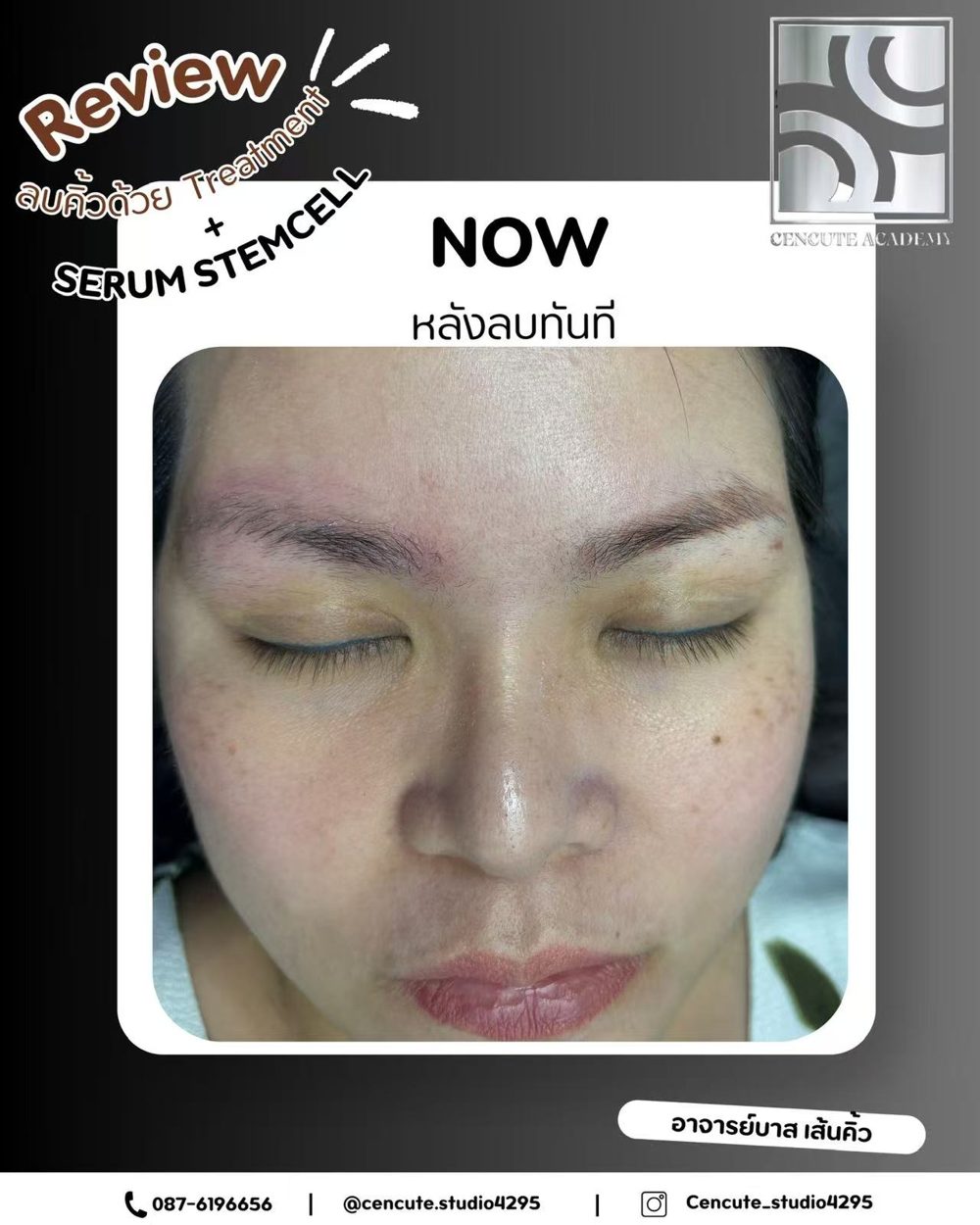ผลงานลบคิ้วด้วยเทคนิคขั้นสูงไร้แผล (Treatment + Serum Stemcell) · Cencute Studio
