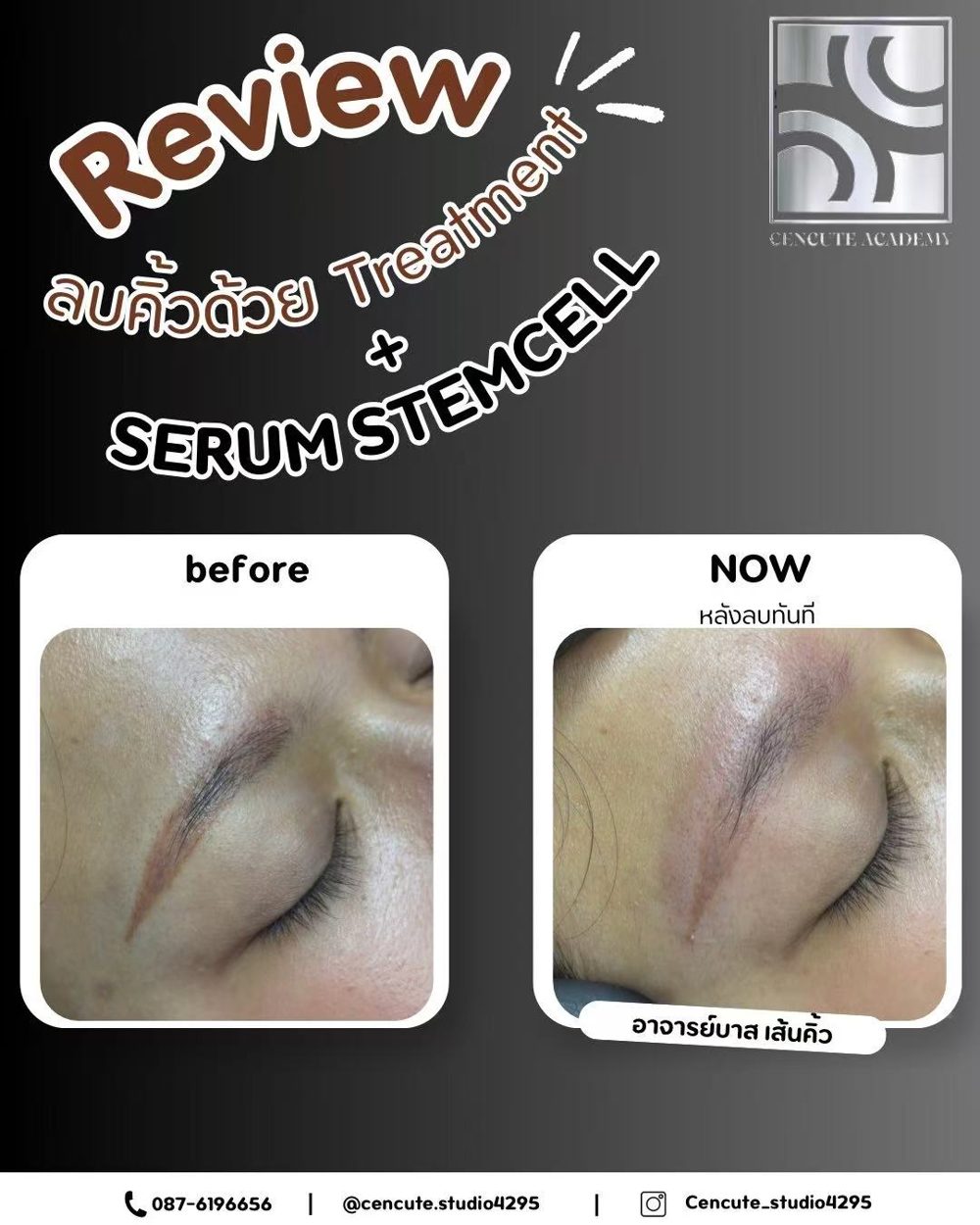 ผลงานลบคิ้วด้วยเทคนิคขั้นสูงไร้แผล (Treatment + Serum Stemcell) · Cencute Studio