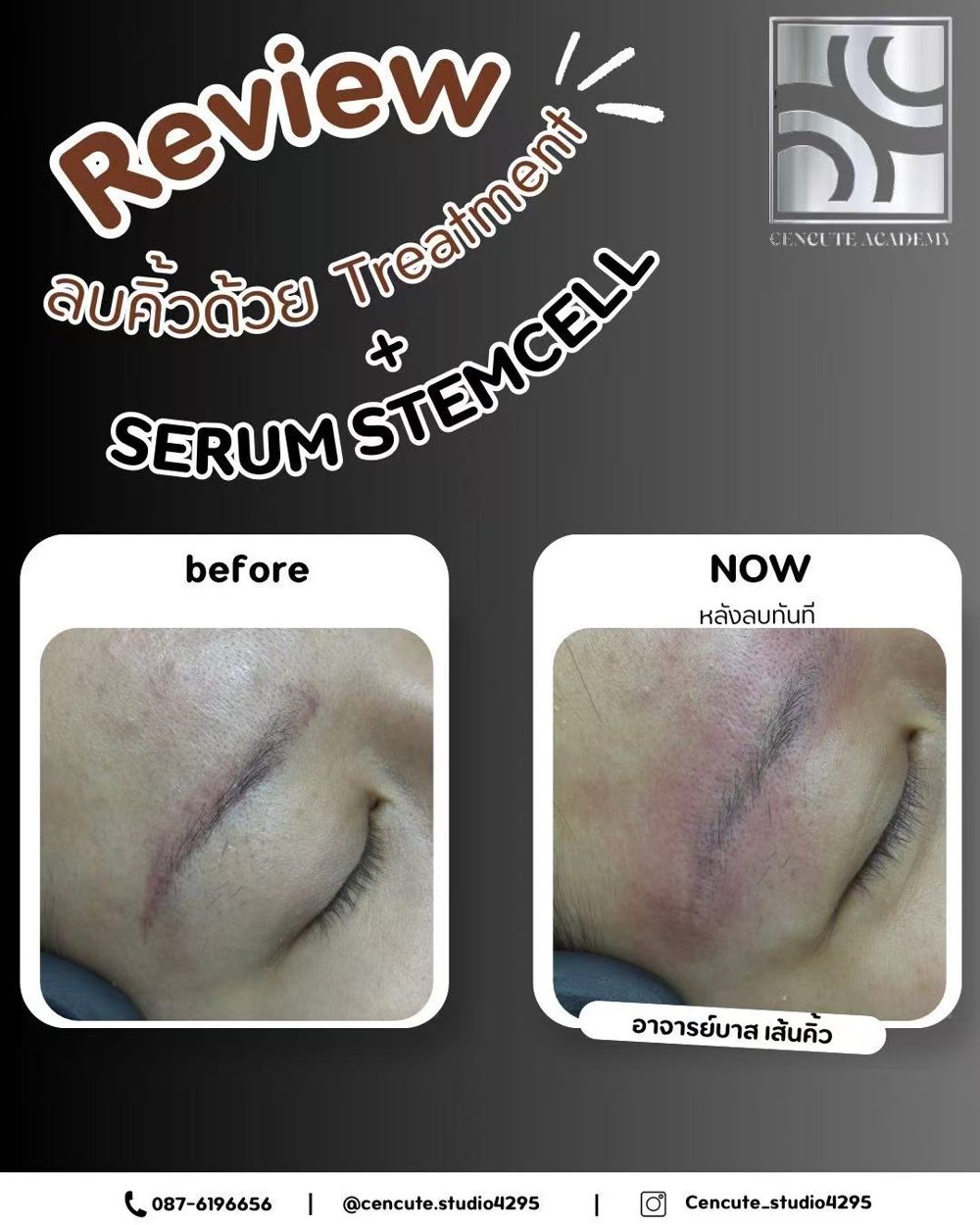 ผลงานลบคิ้วด้วยเทคนิคขั้นสูงไร้แผล (Treatment + Serum Stemcell) · Cencute Studio